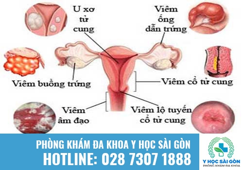 Khí hư có mùi hôi là bệnh gì? Tác hại và cách khắc phục