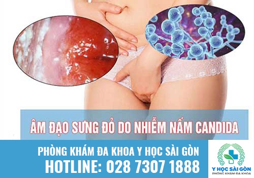 Viêm âm đạo do nấm Candida gây ra triệu chứng khí hư bất thường